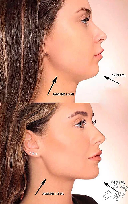  زاویه سازی صورت با ژل بهتره یا چربی, زاویه سازی صورت با ژل, تزریق ژل زاویه فک